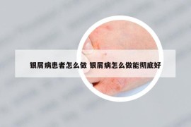 銀屑病患者怎么做 銀屑病怎么做能徹底好