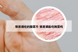 銀屑病吃的酸菜不 銀屑病能吃腌菜嗎