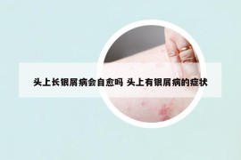 頭上長銀屑病會自愈嗎 頭上有銀屑病的癥狀