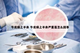 牛皮癬上半身 牛皮癬上半身嚴(yán)重是怎么回事