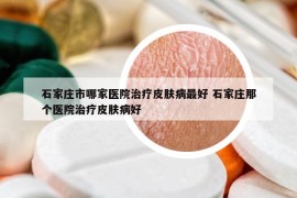 石家莊市哪家醫(yī)院治療皮膚病最好 石家莊那個(gè)醫(yī)院治療皮膚病好
