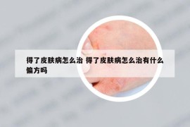 得了皮膚病怎么治 得了皮膚病怎么治有什么偏方嗎