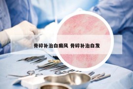 骨碎補治白癜風(fēng) 骨碎補治白發(fā)