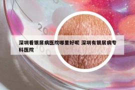 深圳看銀屑病醫(yī)院哪里好呢 深圳有銀屑病?？漆t(yī)院