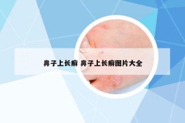 鼻子上長癬 鼻子上長癬圖片大全