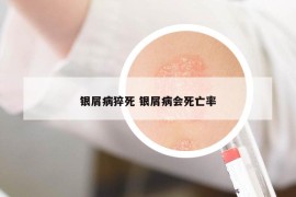 銀屑病猝死 銀屑病會(huì)死亡率