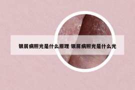 銀屑病照光是什么原理 銀屑病照光是什么光