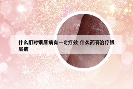 什么酊對銀屑病有一定療效 什么藥膏治療銀屑病