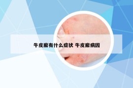牛皮廨有什么癥狀 牛皮廨病因