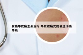 女孩牛皮癬怎么治療 牛皮膚癬女的會(huì)遺傳孩子嗎