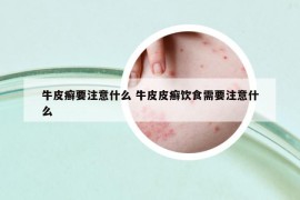 牛皮癬要注意什么 牛皮皮癬飲食需要注意什么