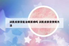 潤肌皮膚膏能治銀屑病嗎 潤肌皮膚膏使用方法