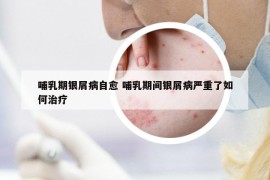 哺乳期銀屑病自愈 哺乳期間銀屑病嚴重了如何治療
