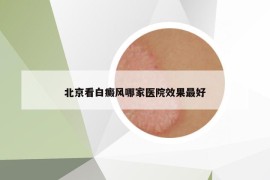 北京看白癜風(fēng)哪家醫(yī)院效果最好