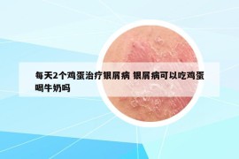 每天2個(gè)雞蛋治療銀屑病 銀屑病可以吃雞蛋喝牛奶嗎