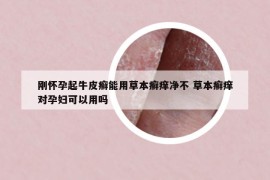 剛懷孕起牛皮癬能用草本癬癢凈不 草本癬癢對(duì)孕婦可以用嗎