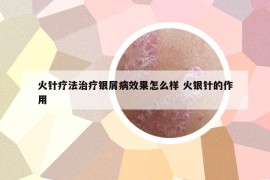 火針療法治療銀屑病效果怎么樣 火銀針的作用