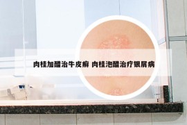 肉桂加醋治牛皮癬 肉桂泡醋治療銀屑病