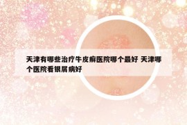 天津有哪些治療牛皮癬醫(yī)院哪個最好 天津哪個醫(yī)院看銀屑病好