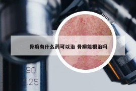 骨癬有什么藥可以治 骨癬能根治嗎