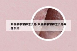 銀屑病非常癢怎么辦 銀屑病非常癢怎么辦用什么藥