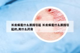 長(zhǎng)皮癬是什么原因引起 長(zhǎng)皮癬是什么原因引起的,用什么藥膏