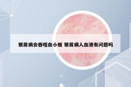 銀屑病會(huì)吞噬血小板 銀屑病人血液有問題嗎