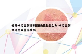 使用卡泊三醇搽劑面部爆皮怎么辦 卡泊三醇涂抹后大量掉皮屑