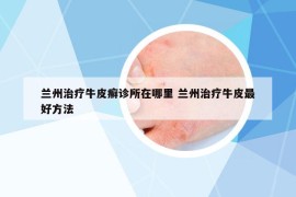 蘭州治療牛皮癬診所在哪里 蘭州治療牛皮最好方法