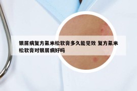 銀屑病復(fù)方氟米松軟膏多久能見(jiàn)效 復(fù)方氟米松軟膏對(duì)銀屑病好嗎