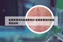 起銀屑病流的血是黑色的 起銀屑病流的血是黑色的嗎