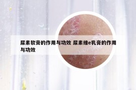 尿素軟膏的作用與功效 尿素維e乳膏的作用與功效
