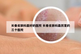 長春皮膚科最好的醫(yī)院 長春皮膚科最厲害的三個(gè)醫(yī)院