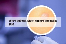 沈陽(yáng)牛皮癬惟南風(fēng)超好 沈陽(yáng)治牛皮屑哪家醫(yī)院好
