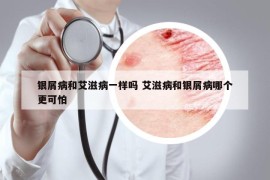 銀屑病和艾滋病一樣嗎 艾滋病和銀屑病哪個更可怕