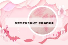 祖?zhèn)髋Ｆぐ_外用秘方 牛皮癬的外用