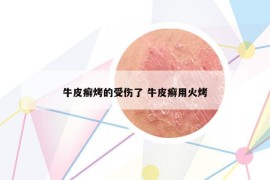 牛皮癬烤的受傷了 牛皮癬用火烤