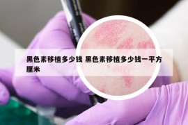 黑色素移植多少錢 黑色素移植多少錢一平方厘米