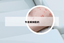 牛皮癬抹臉的