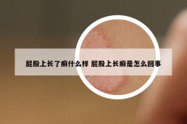 屁股上長了癬什么樣 屁股上長癬是怎么回事