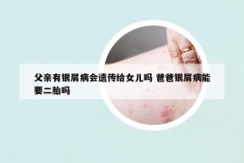 父親有銀屑病會遺傳給女兒嗎 爸爸銀屑病能要二胎嗎