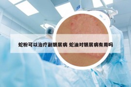 蛇粉可以治療副銀屑病 蛇油對(duì)銀屑病有用嗎