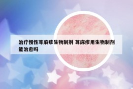 治療慢性蕁麻疹生物制劑 蕁麻疹用生物制劑能治愈嗎