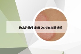 敷冰片治牛皮癬 冰片治皮膚病嗎