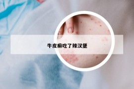 牛皮癬吃了辣漢堡