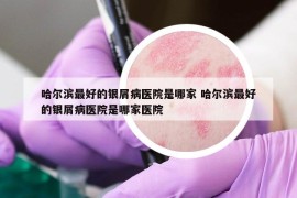 哈爾濱最好的銀屑病醫(yī)院是哪家 哈爾濱最好的銀屑病醫(yī)院是哪家醫(yī)院