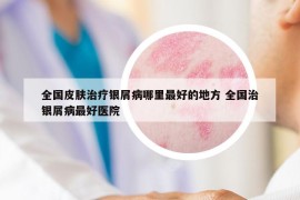 全國皮膚治療銀屑病哪里最好的地方 全國治銀屑病最好醫(yī)院