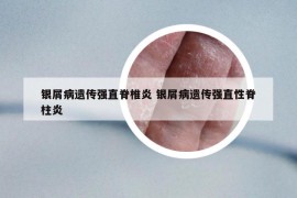 銀屑病遺傳強(qiáng)直脊椎炎 銀屑病遺傳強(qiáng)直性脊柱炎