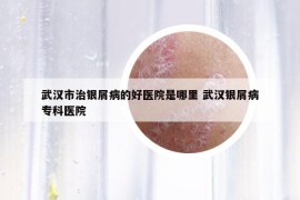 武漢市治銀屑病的好醫(yī)院是哪里 武漢銀屑病專科醫(yī)院