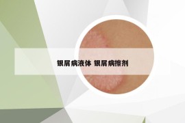銀屑病液體 銀屑病擦劑
